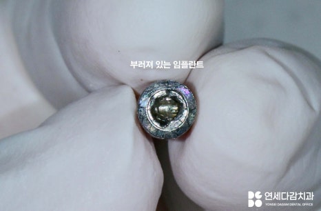 어금니 찌릿한 통증 치아에 금갔을때 신경치료 크라운 가락시장역 치과 충치 깊을 때 당일 발치 임플란트 및 부러진 보철 임플란트재식립 관련 이미지 10