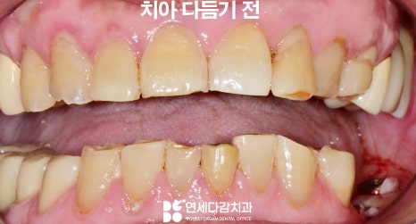 하얀 치아가 가져오는 인상의 변화 오금동 치과 교정 없이 최소삭제 라미네이트 심미치료 통해 치열 및 누렁니 개선 관련 이미지 4