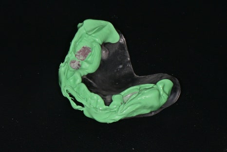 Songpa Station Dentist: Have You Been Using Dentures for a Long Time? <Digital Guided Implants> image 6