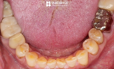 어금니 찌릿한 통증 치아에 금갔을때 신경치료 크라운 가락시장역 치과 충치 깊을 때 당일 발치 임플란트 및 부러진 보철 임플란트재식립 관련 이미지 14