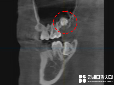 매복 사랑니 옆에 또 다른 치아 이것은 무엇일까요 송파구 가락동 치과 에서 알려드리겠습니다. 관련 이미지 3