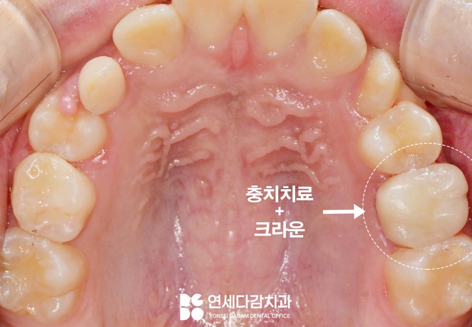 유치 빠지고 영구치 나는 시기 지났는데도 안 나온다면 문정역 치과 선천적 결손 치아 자리 지키기 위한 비발치 충치 치료 크라운 관련 이미지 4