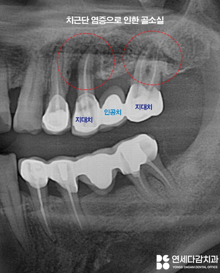 문정역 치과 임플란트 오래 사용하기 위해서 지대주 (어버트먼트) 보철 종류 기성 및 커스텀 지대주 (abutment) 차이 알고 받아야 되는 이유 관련 이미지 3