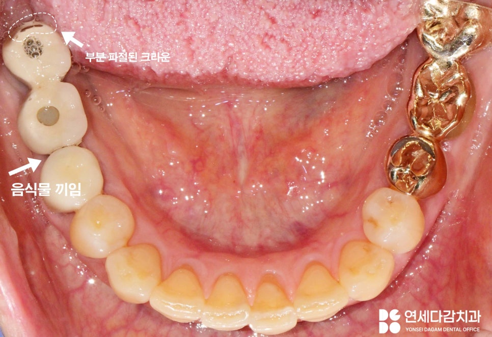 오래된 임플란트 다시 수술하지 않고 크라운 교체만 가능할까 문정동 치과 SCRP 타입으로 보철 재제작 관련 이미지 1
