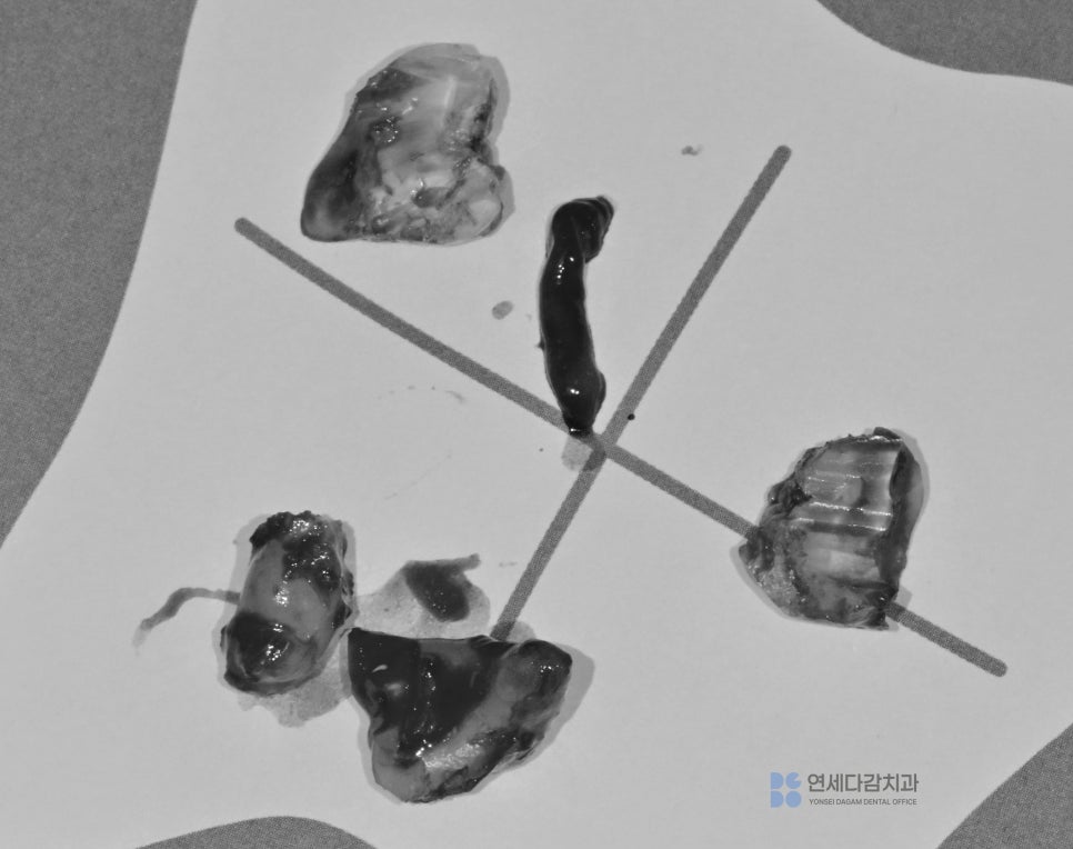 오금역 치과 후방 경사 부분 매복 사랑니, 조기 진단과 안전한 치료를 위한 가이드 관련 이미지 6