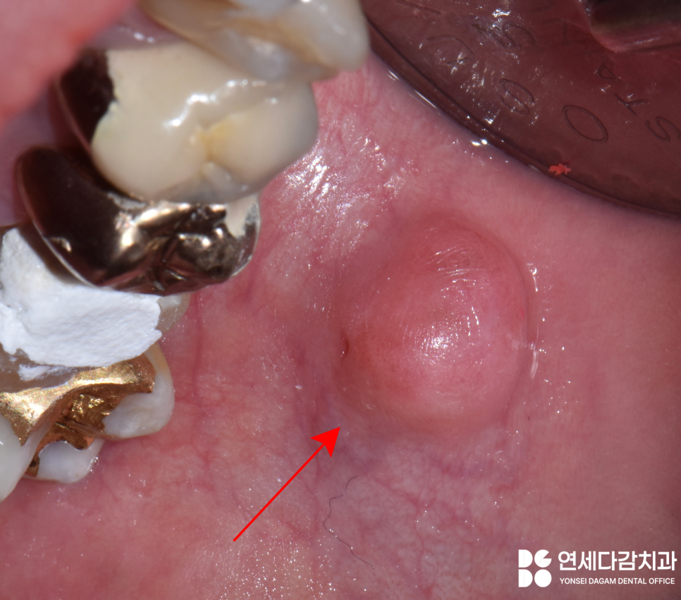 입안에 혹이 느껴진다면 외상성 섬유종 의심해 볼 수 있습니다 개롱역 치과 에서 알려드리는 원인과 치료방법 관련 이미지 4