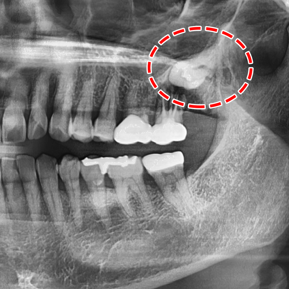 연세다감치과 대표원장의 사랑니 꼭 뽑아야 될까? 통합치의학과 전문의가 알려주는 기준 관련 이미지 2