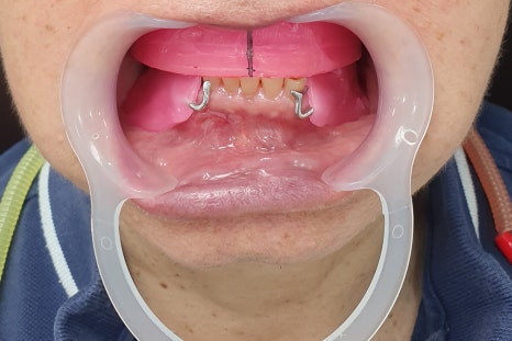 Seokchon-dong Dental Clinic, 연세다감치과: Why You Should Carefully Review the Denture-Making Steps · Process from the Beginning image 1