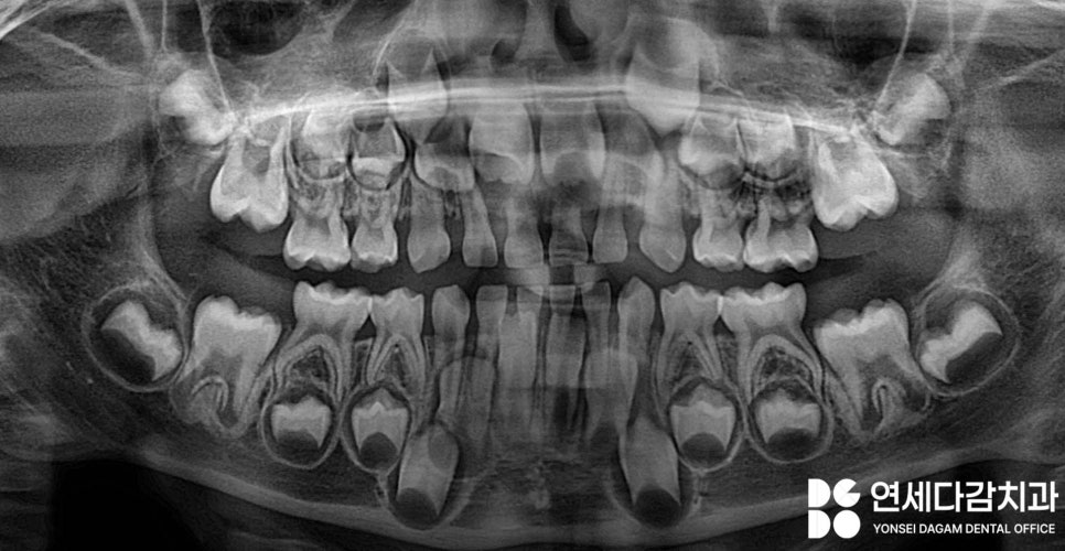 아이가 앞으로 넘어졌을 때 앞니 치료 확인법 거여역 치과 소아 치아 외상의 이해와 관리 관련 이미지 5