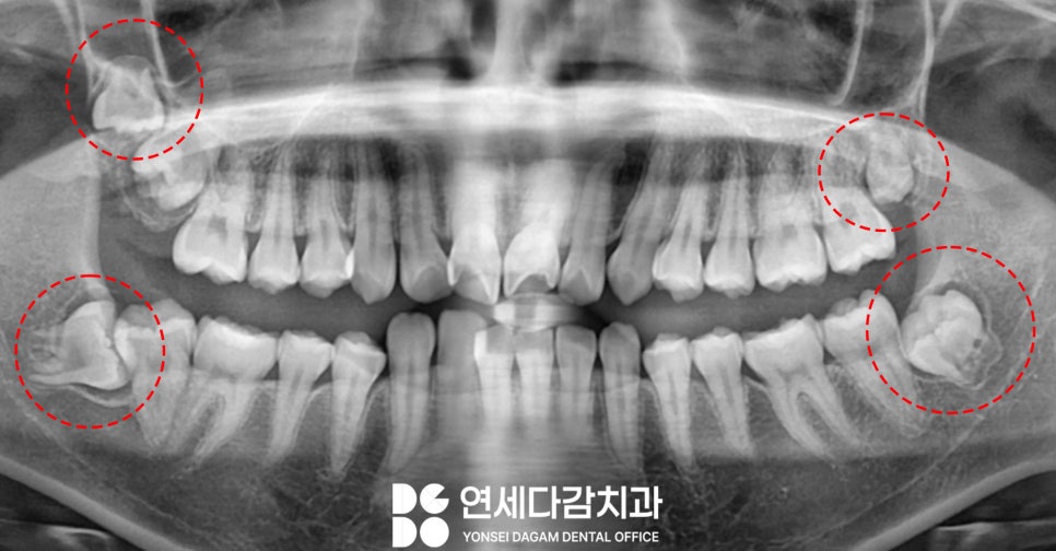 교정 중 사랑니 발치 진단 오금동 치과 에서 설측 수평 매복 발치 과정 알려드리겠습니다. 관련 이미지 1