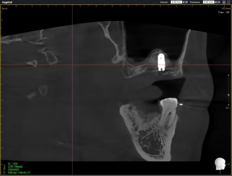 Why a Sinus Lift May Be Needed When There Is Insufficient Bone for Implants in Munjeong-dong image 5