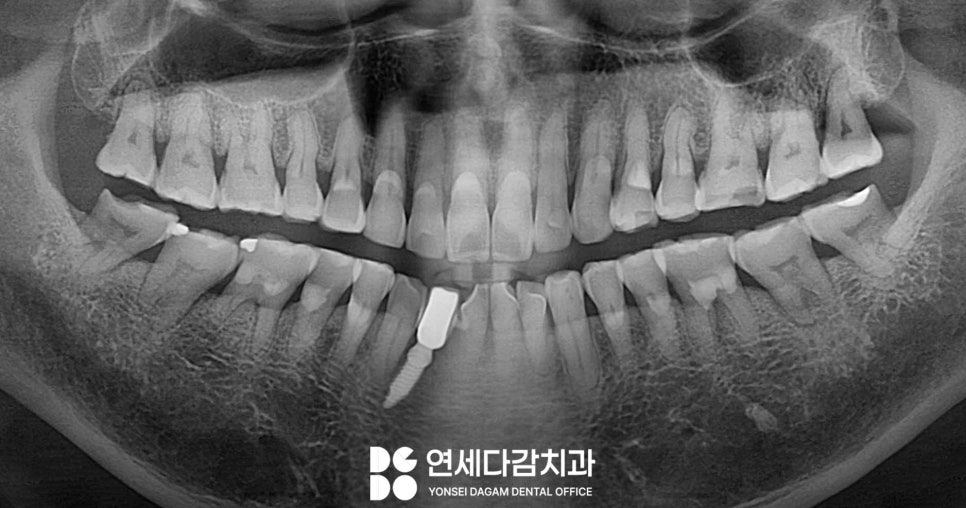 심한 이갈이 원인으로 생기는 치아 마모 및 파절 문제 문정역 치과 교모증 크라운 치료 필요한 이유 관련 이미지 3