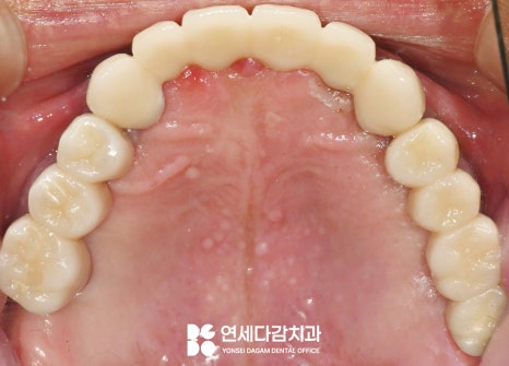 불편한 틀니 임플란트로 바꿔 치료할 수 있을지 가락시장역 치과 에서 살펴봅시다. 관련 이미지 9