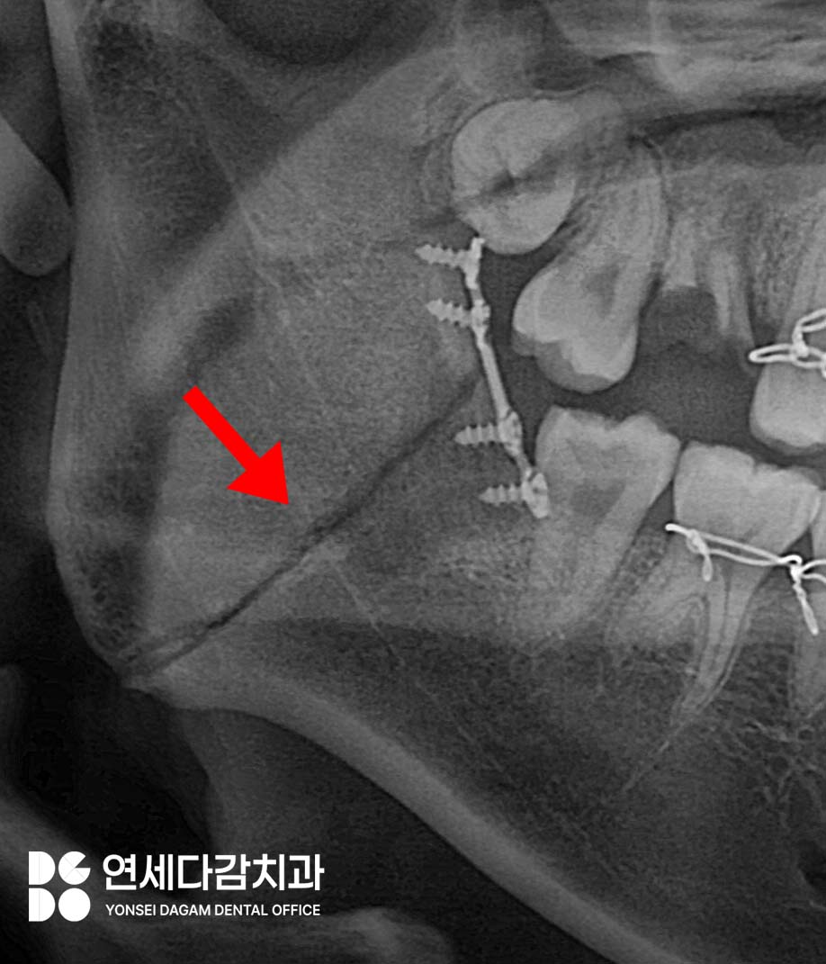 문정역 치과 에서 알아보는 턱뼈 골절 됐을 때 악간고정술 치료 같이 진행하는 이유 관련 이미지 2