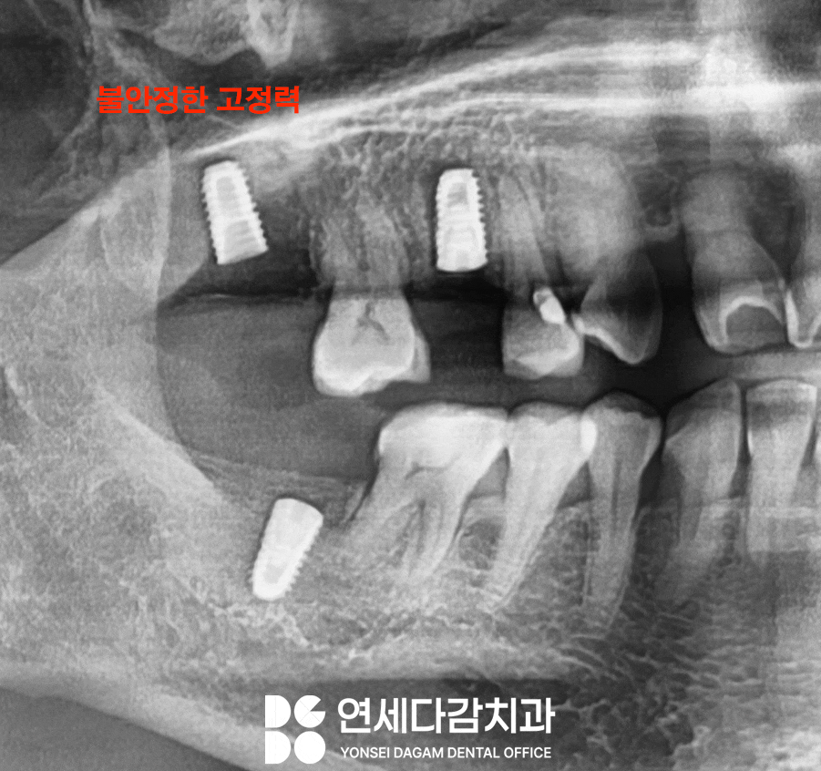 임플란트 재수술 가락동 치과 정밀한 분석과 전략적 접근 통한 치유 과정 관련 이미지 1