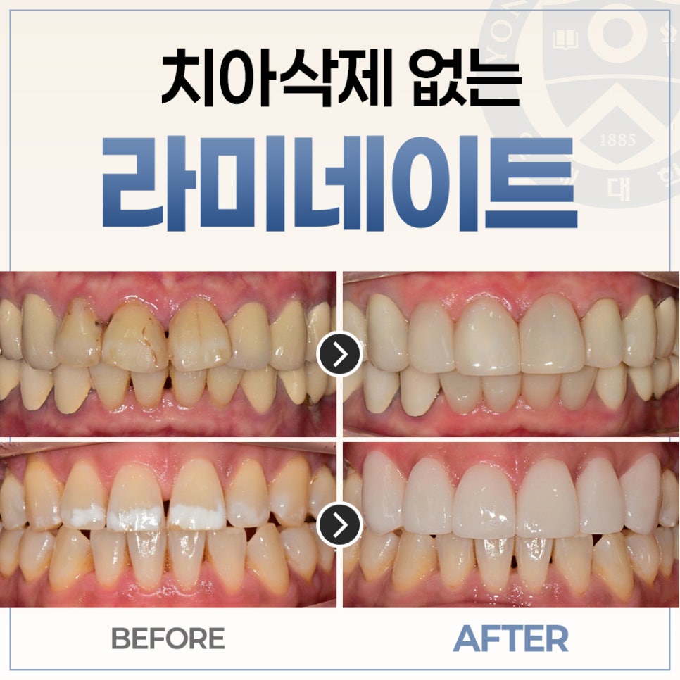 무삭제 라미네이트 관련 이미지 1