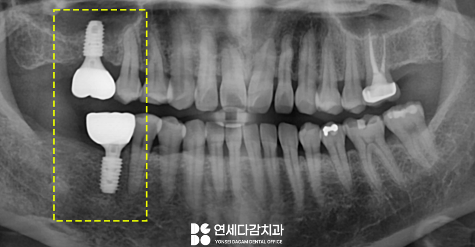 발치 후 생기는 잇몸뼈의 변화로 임플란트 과정이 복잡해질 수 있습니다 경찰병원역 치과 에서 알아보는 상악동 거상술. 관련 이미지 5