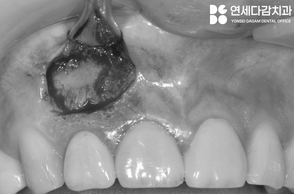 치아 발치를 피하기 위한 마지막 수단 MTA 이용한 가락동 치과 치근단 절제술 과정 살펴봅시다. 관련 이미지 3