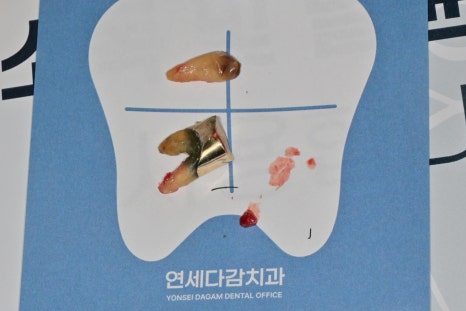 Munjung-dong Dentist: What Does Tooth Attrition Mean, What Are Its Symptoms, and How Is It Treated? image 9