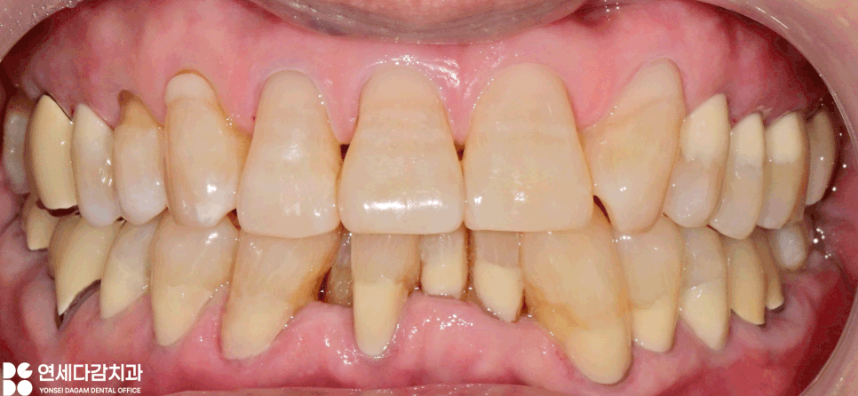 치아 이시림 왜 더 심해질까 개롱역 치과 치경부 마모증 원인과 레진 충전 및 글래스아이오노머(GI) 치료 특징 비교 관련 이미지 5