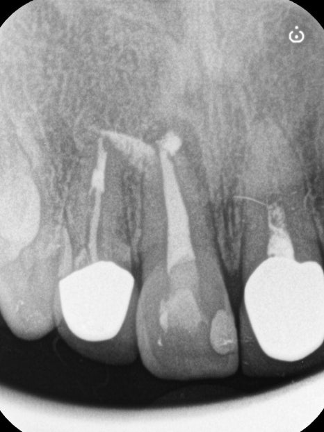 Macheon-dong Dental Clinic: Why Treating Root Inflammation Comes First Before an Anterior Crown image 4