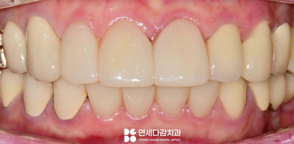 앞니 레진 후 생긴 변색 문제와 삐뚤어진 치아 개롱역 치과 최소삭제 라미네이트 적용할 수 있는 이유 관련 이미지 7