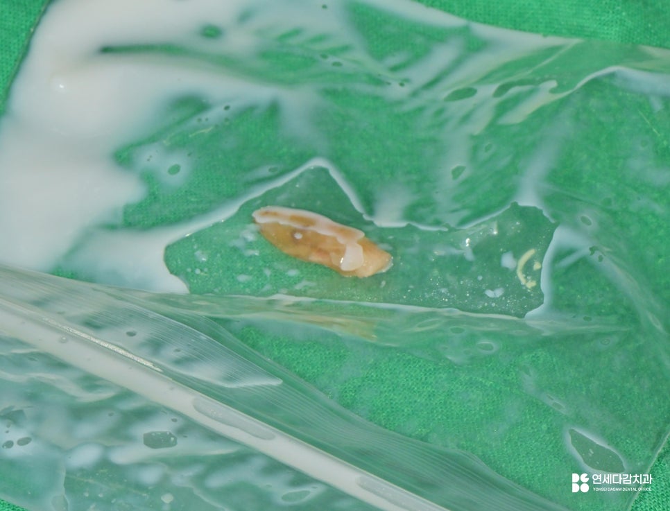치주염으로 인한 앞니 탈구, 개롱역 치과 에서 설명하는 잠간 고정술 이야기 관련 이미지 3