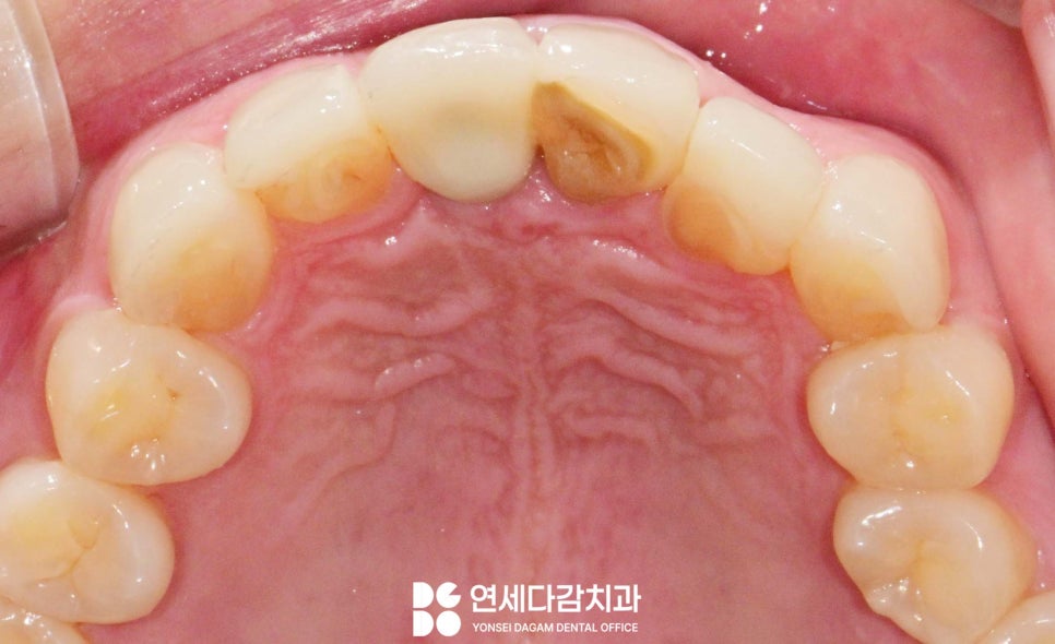 앞니 벌어짐 거여동 치과 치은성형술 동반하여 교정 없이 크라운 교체 및 최소삭제 라미네이트 통한 심미 치료 관련 이미지 5