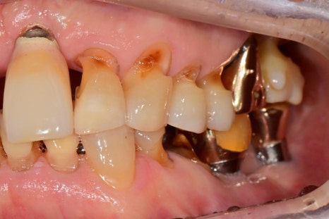 Munjung-dong Dentist: What Does Tooth Attrition Mean, What Are Its Symptoms, and How Is It Treated? image 1