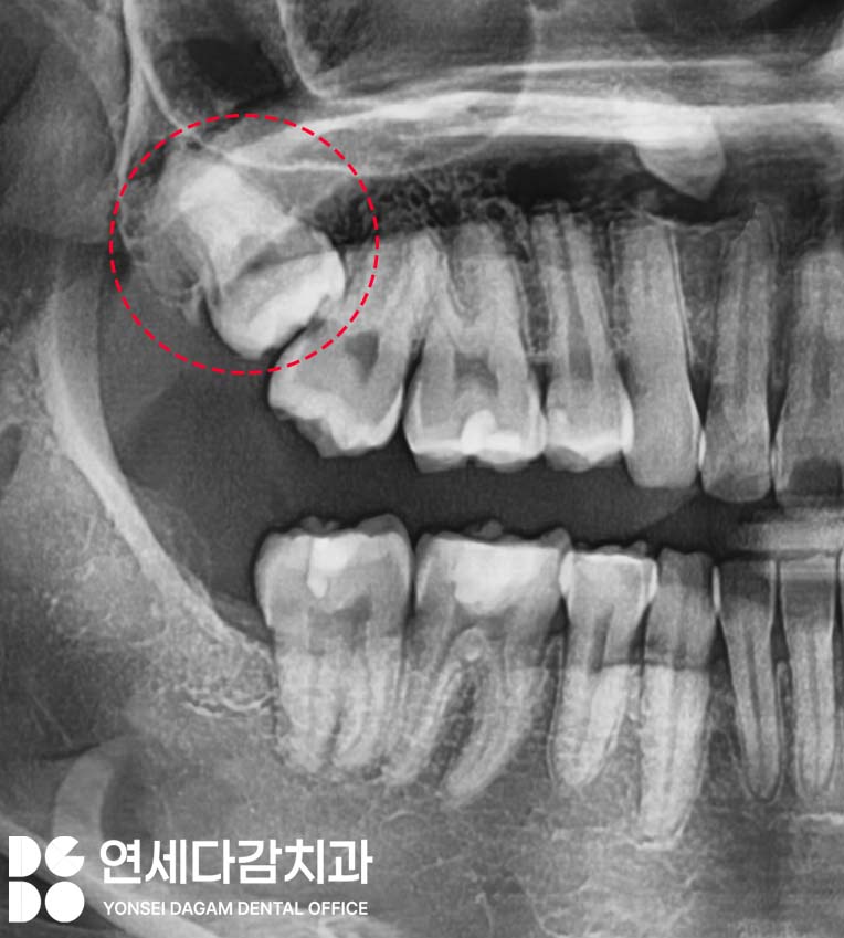 기울어진 매복 사랑니 발치 더 주의깊게 봐야 되는 이유 개롱역 치과 에서 살펴봅시다. 관련 이미지 2