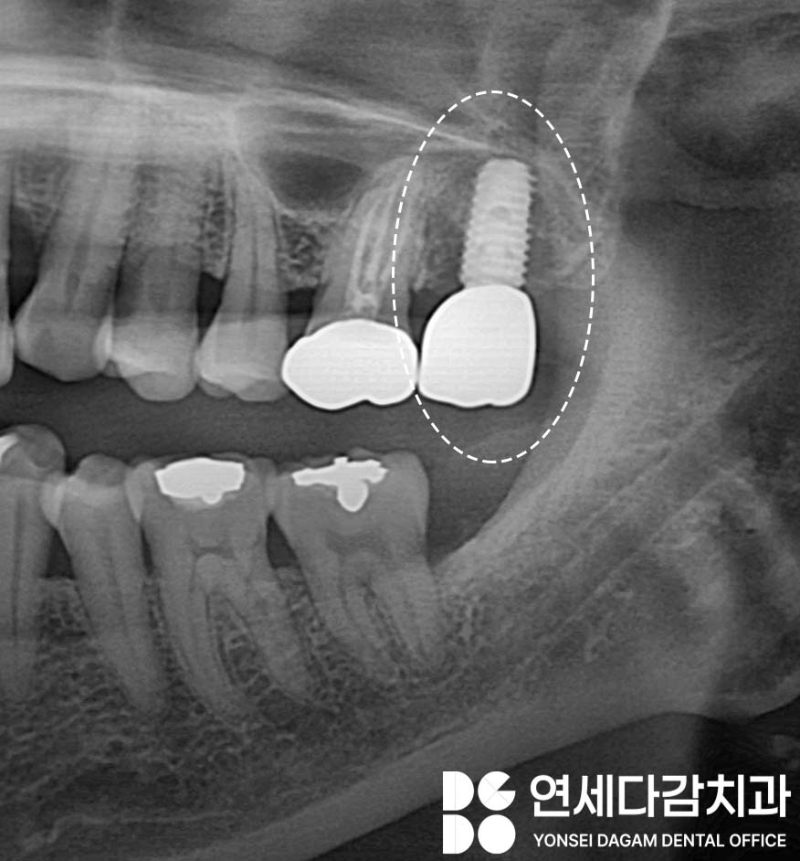 송파구 가락동 치과 공포증 완화 위한 수면마취 임플란트 의식하진정법에 사용되는 미다졸람 특징 및 장점과 부작용에 관한 이야기 관련 이미지 4