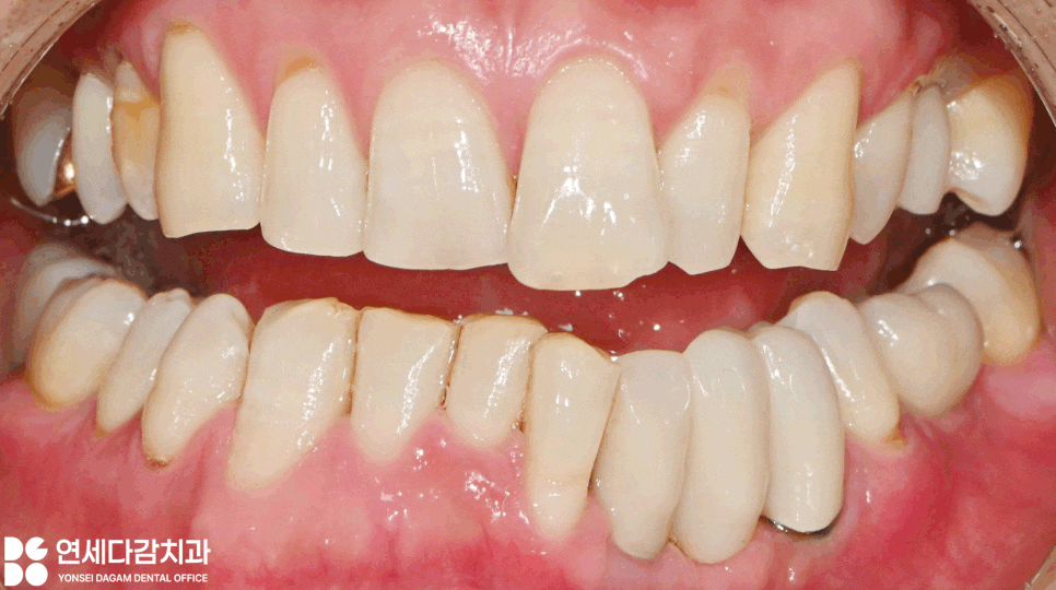 심한 골소실에도 임플란트 가능할까요 가락시장역 치과 뼈이식 통한 안정적인 고정력 확보 과정 관련 이미지 4