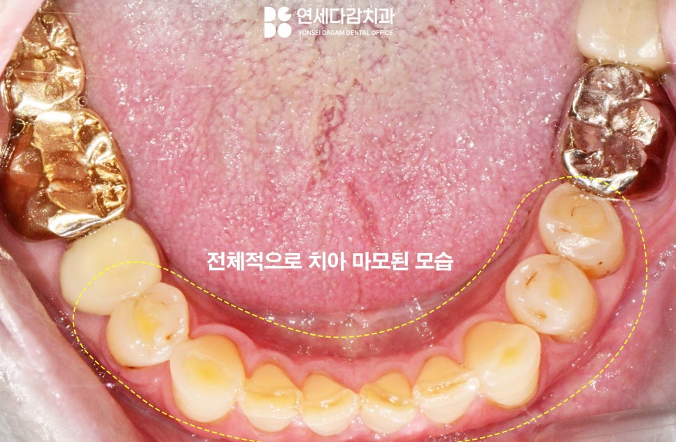 어금니 찌릿한 통증 치아에 금갔을때 신경치료 크라운 가락시장역 치과 충치 깊을 때 당일 발치 임플란트 및 부러진 보철 임플란트재식립 관련 이미지 2