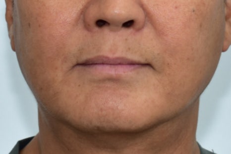 Munjeong-dong Full-Mouth Dental Implants: Why Did the Patient’s Appearance Change After Simply Replacing the Teeth? image 9