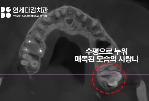 상악동 또는 신경 가까운 누워있는 매복 사랑니 가락시장역 치과 단순 발치를 위한 필수 CT 분석 과정 관련 이미지 3