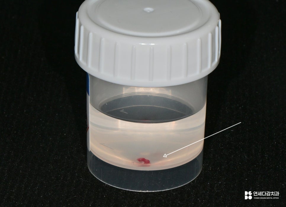 개롱역 치과 혀에 하얀 돌기? 구강 유두종 작아도 조직검사가 필요한 이유 관련 이미지 6