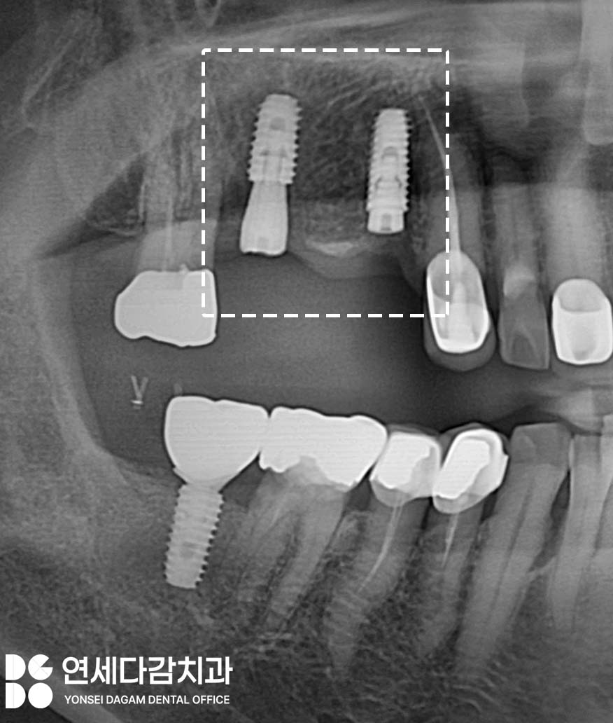 크라운 또는 브릿지 같은 보철 치료 했던 부위에 충치 또는 잇몸질환 생기는 이유 가락시장역 치과 치근우식 생겼을 때 발치 후 임플란트 관련 이미지 4