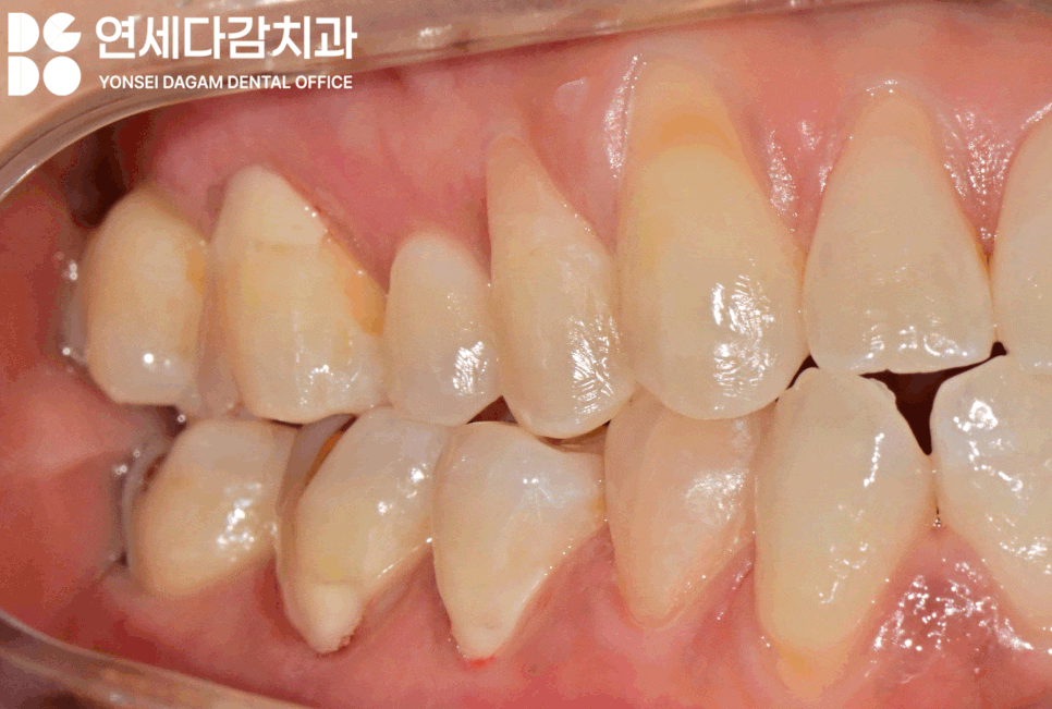 이시림 원인 치경부 마모증 치료할 때 쓰이는 문정역 치과 레진과 G.I 재료의 특성 관련 이미지 7