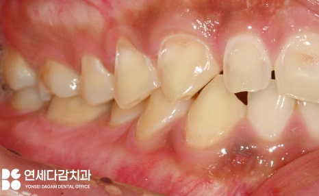 마모로 인한 치아 교모증 문정동 치과 에서 원인과 크라운 치료 방법 알려드리겠습니다. 관련 이미지 2