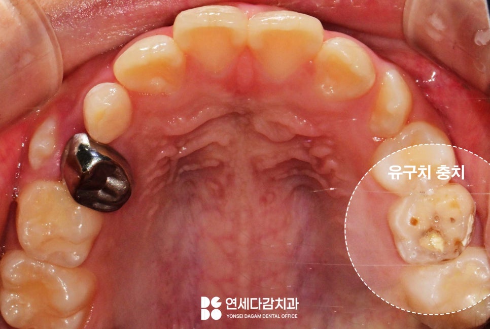 유치 빠지고 영구치 나는 시기 지났는데도 안 나온다면 문정역 치과 선천적 결손 치아 자리 지키기 위한 비발치 충치 치료 크라운 관련 이미지 3