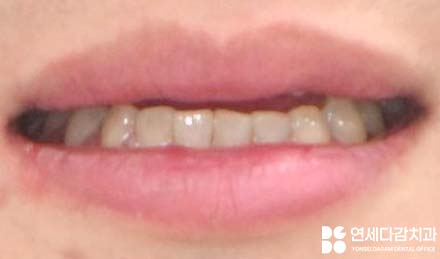 앞니 벌어짐 거여동 치과 치은성형술 동반하여 교정 없이 크라운 교체 및 최소삭제 라미네이트 통한 심미 치료 관련 이미지 7