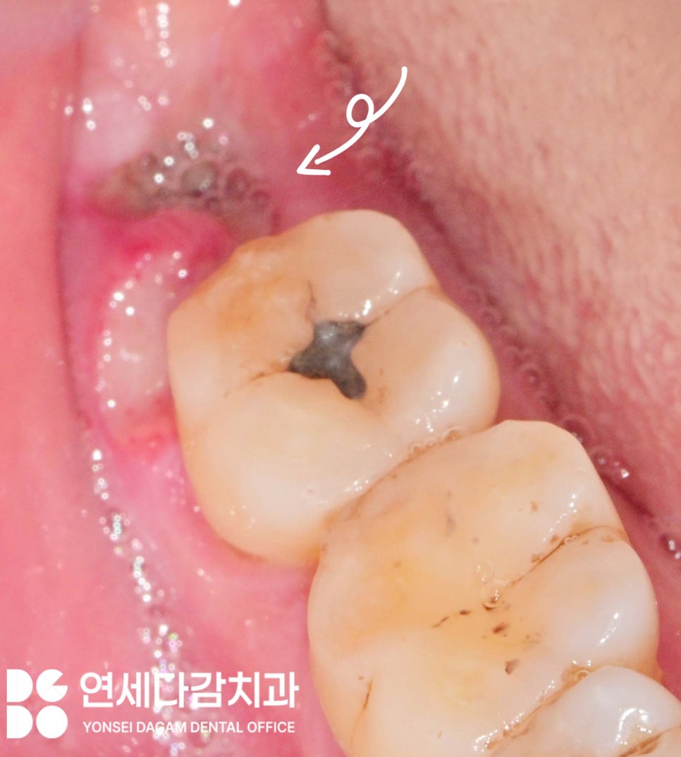 If the gums keep swelling and pus keeps coming out after impacted wisdom tooth extraction, how to find tooth root fragments remaining in the jawbone at a dental clinic in Songpa District image 1