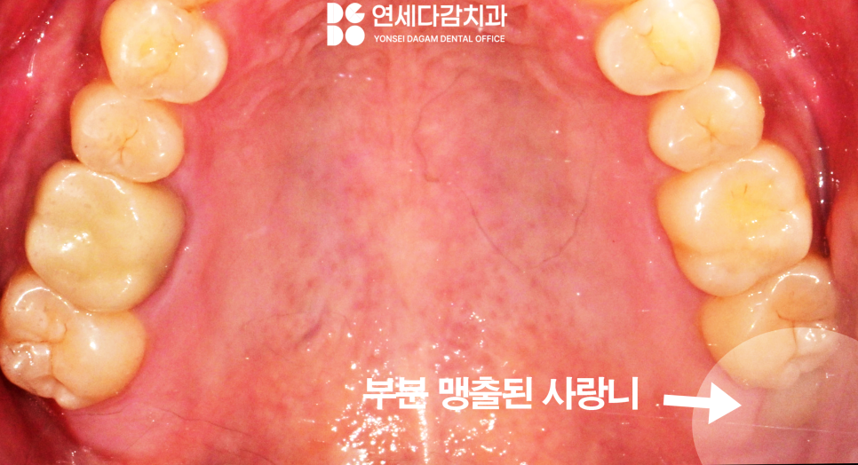 상악동 또는 신경 가까운 누워있는 매복 사랑니 가락시장역 치과 단순 발치를 위한 필수 CT 분석 과정 관련 이미지 4