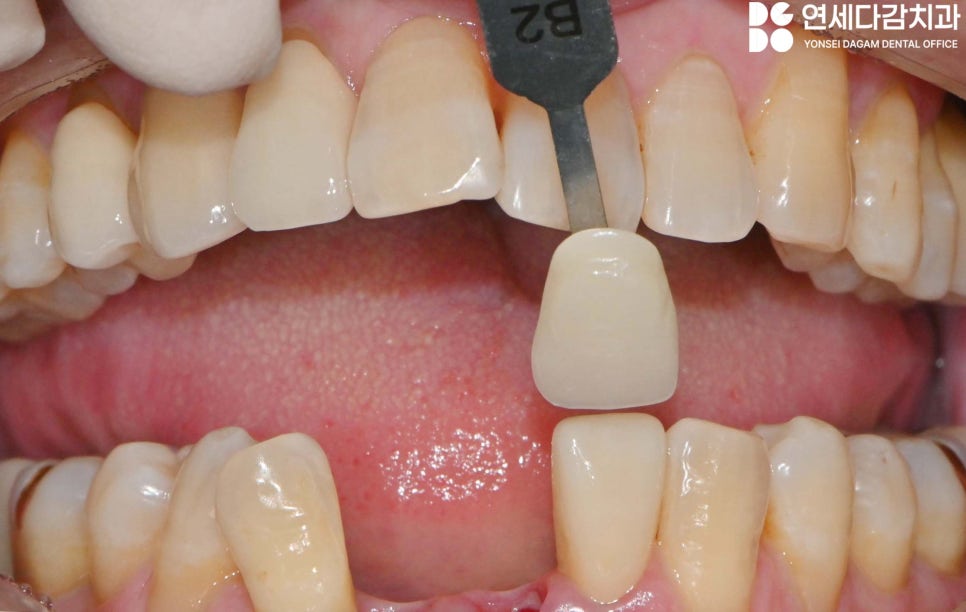 유독 까다로운 수술 부위가 있다? 오금역 치과 브릿지에서 임플란트 전환 과정 관련 이미지 6