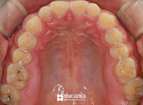 마모로 인한 치아 교모증 문정동 치과 에서 원인과 크라운 치료 방법 알려드리겠습니다. 관련 이미지 4
