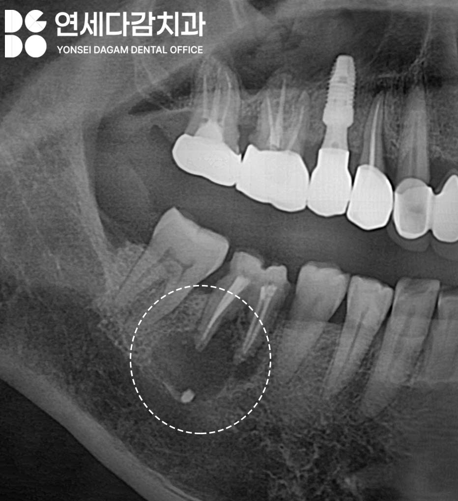 신경치료 후 크라운 떨어짐 원인으로 감염된 충치 치료 미루다 잇몸뼈 녹음 증상 개롱역 치과 발치 후 치근단 낭 적출술 관련 이미지 2
