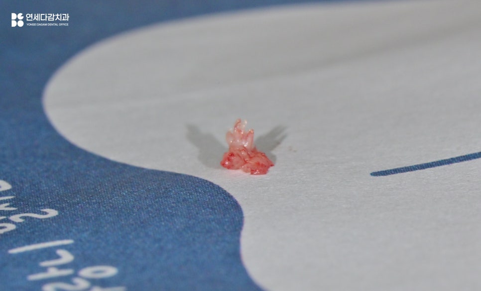 A Bump on the Side of the Tongue: From the Appearance of Oral Papilloma to Treatment | Gaerong Station Dental Clinic image 6