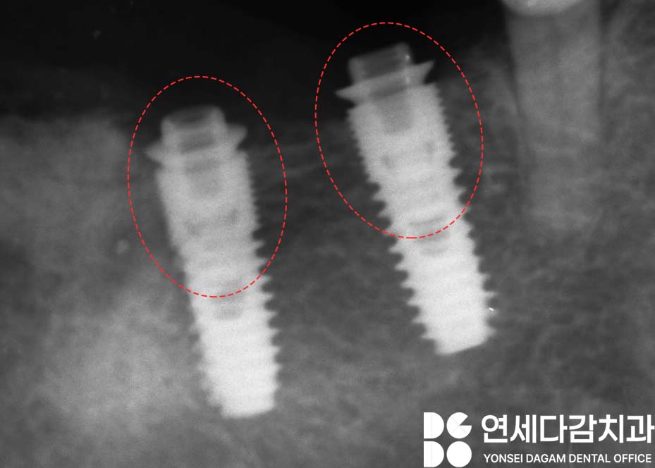 오래된 임플란트 다시 수술하지 않고 크라운 교체만 가능할까 문정동 치과 SCRP 타입으로 보철 재제작 관련 이미지 6