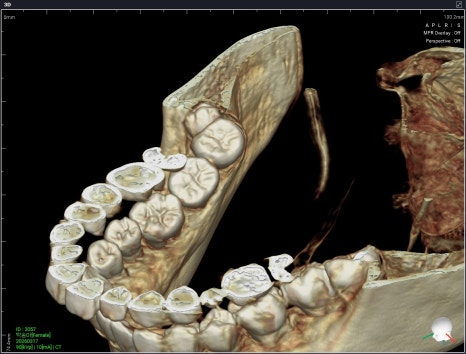 Garak-dong Wisdom Tooth Extraction: What If Two Wisdom Teeth Grew Fused Together? [A Case of Fused Wisdom Tooth Extraction] image 6