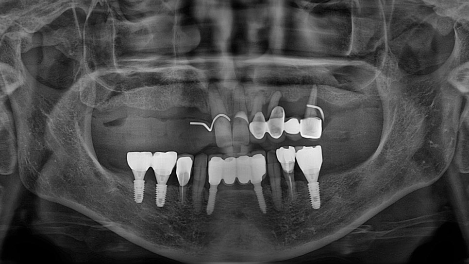 Prosthetics After Implants in Ogeum-dong: Occlusion and Facial Balance Matter Too image 1